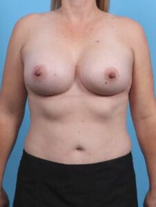 Breast Augmentation - Case 30104 - After
