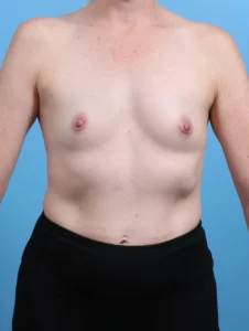 Breast Augmentation - Case 30294 - Before