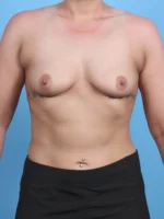 Breast Augmentation - Case 30286 - Before