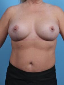 Breast Lift/Reduction with Implants - Case 30390 - After