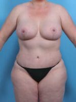 Breast Lift/Reduction with Implants - Case 30381 - After