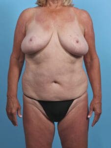 Breast Lift/Reduction w/o Implants - Case 30310 - Before