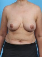 Breast Lift/Reduction w/o Implants - Case 30238 - After