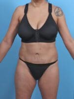 Tummy Tuck - Case 30438 - After