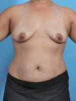 Breast Augmentation - Case 44815 - Before