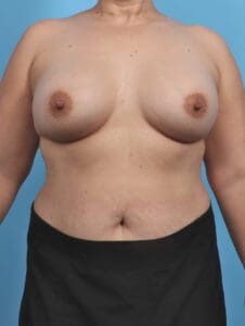 Breast Augmentation - Case 44815 - After