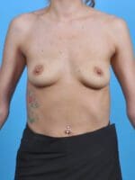 Breast Augmentation - Case 44822 - Before
