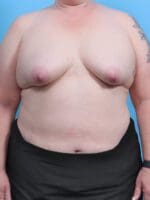 Breast Lift/Reduction with Implants - Case 44836 - Before