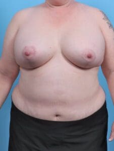 Breast Lift/Reduction with Implants - Case 44836 - After