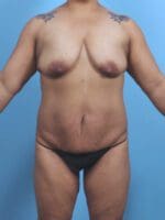 Breast Lift/Reduction with Implants - Case 44850 - Before