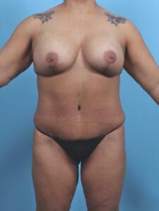 Breast Lift/Reduction with Implants - Case 44850 - After