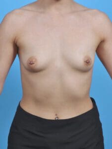 Breast Augmentation - Case 44874 - Before