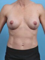 Breast Implant Revision - Case 44881 - After