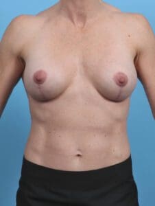 Breast Implant Revision - Case 44881 - After