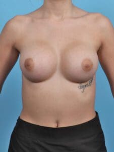 Breast Augmentation - Case 44916 - After