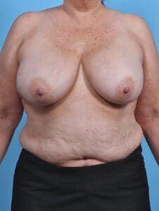 Breast Implant Removal - Case 44967 - Before
