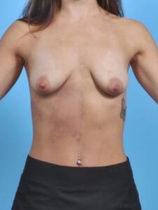 Breast Lift/Reduction with Implants - Case 45196 - Before