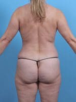Liposuction - Case 45282 - After