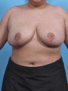 Breast Lift/Reduction w/o Implants - Case 45295 - After