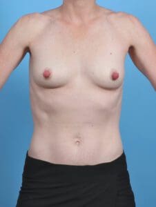 Breast Augmentation - Case 45369 - Before