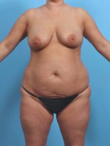 Breast Lift/Reduction with Implants - Case 45394 - Before