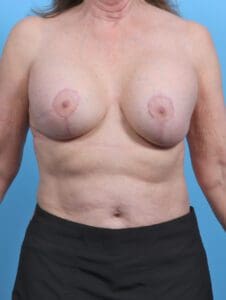 Breast Implant Revision - Case 45568 - Before