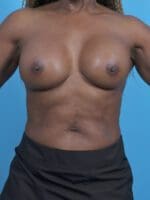 Breast Augmentation - Case 45610 - After