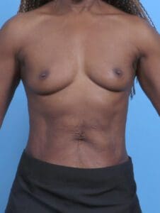 Breast Augmentation - Case 45610 - Before
