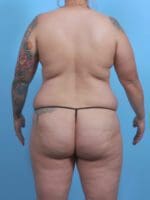 Liposuction - Case 45642 - Before