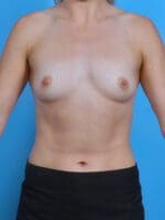 Breast Augmentation - Case 45688 - Before