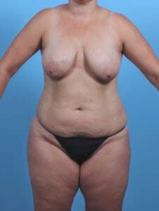 Breast Lift/Reduction with Implants - Case 45704 - Before