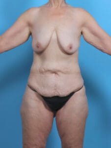 After Weight Loss - Case 45722 - Before