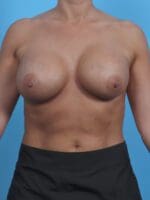 Breast Augmentation - Case 45781 - After