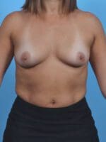 Breast Augmentation - Case 45781 - Before