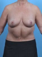 Breast Lift/Reduction w/o Implants - Case 45789 - After