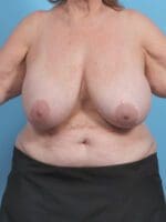 Breast Implant Revision - Case 45805 - Before