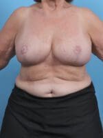 Breast Implant Revision - Case 45805 - After
