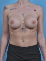 Breast Augmentation - Case 45996 - After