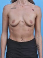 Breast Augmentation - Case 45996 - Before