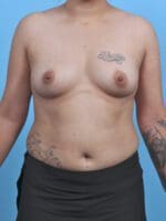 Breast Augmentation - Case 46013 - Before
