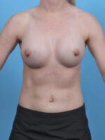 Breast Augmentation - Case 46247 - After