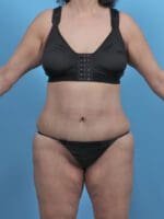 Tummy Tuck - Case 46269 - After
