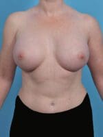 Breast Augmentation - Case 46308 - After