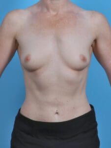 Breast Augmentation - Case 46308 - Before