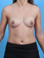 Breast Augmentation - Case 46324 - Before