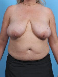 Breast Lift/Reduction w/o Implants - Case 46340 - Before