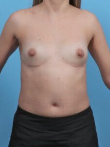 Breast Implant Removal - Case 46396 - After