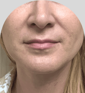 Lip Fillers - Case 46440 - Before