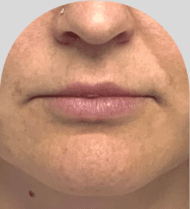 Lip Fillers - Case 46444 - Before