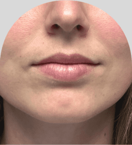 Lip Fillers - Case 46448 - Before